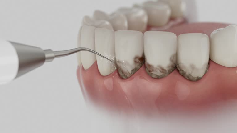 Trusted Tooth Extraction service in Pierceton, IN - Dentist Open Now